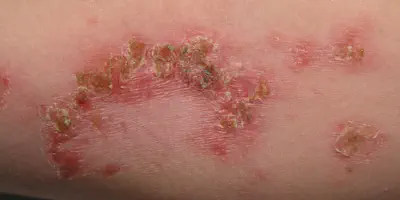 Arm Tattoo Infektion: Ursachen, Symptome und Behandlung