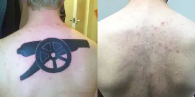 Tut ein Tattoo am äußeren Arm weh?