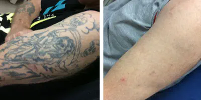 Prothesenarm Tattoo: Alles, was Sie wissen müssen