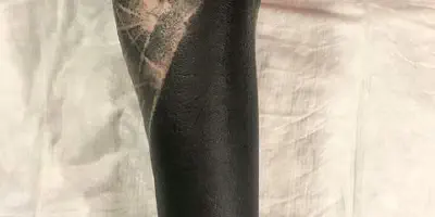 Die vollständige Entfernung von Arm-Tattoos